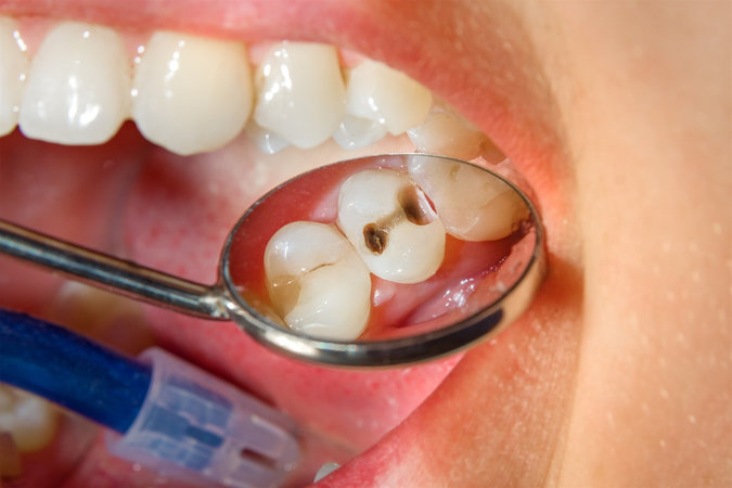 Какая пища позволит избежать кариеса, а какая принесет зубам вред