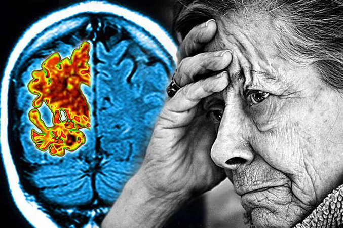 Болезнь Альцгеймера — этот глазной симптом указывает на то, что вы находитесь в группе риска