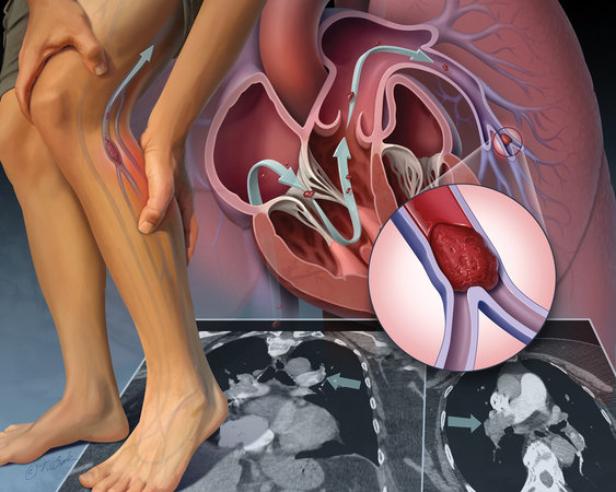 Необычные признаки закупорки артерий и болезней сердца