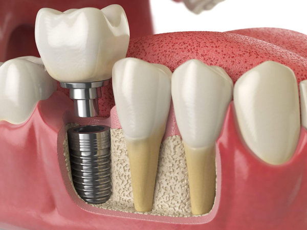 Имплантаты - не единственный вариант лечения стоматологических проблем