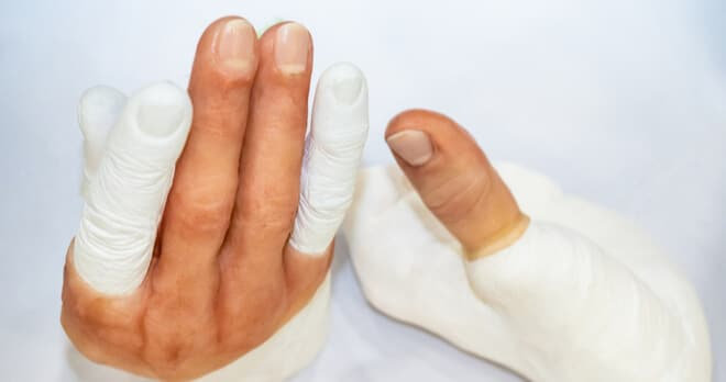 Заболевание, приводящая к ампутации пальцев