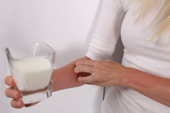 9 симптомов аллергии на молоко