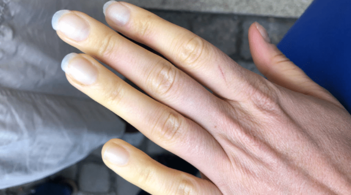 Новый симптом К-19: «ковидные пальцы»