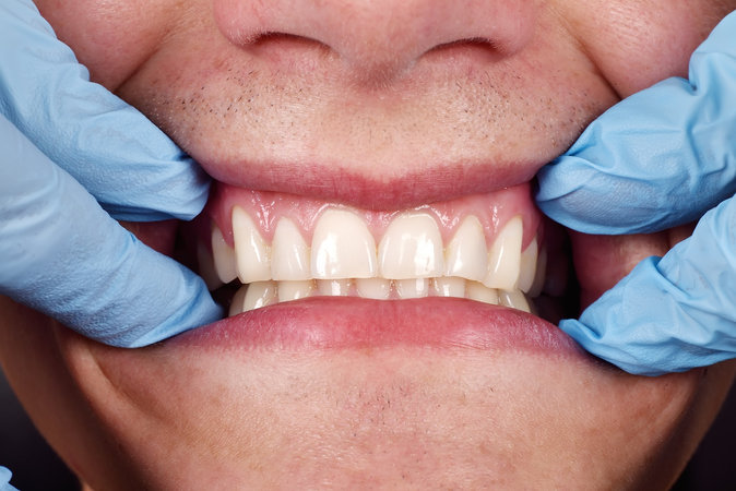 Рак зубов: что это такое и можем ли мы с этим бороться
