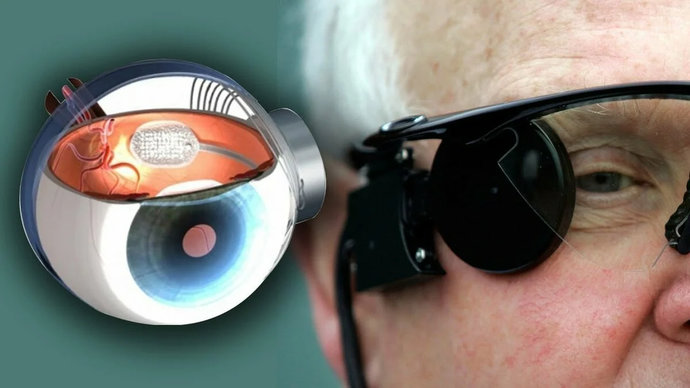 Имплантация сетчатки позволит вернуть зрение ослепшим людям