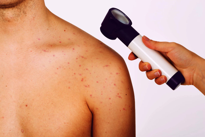Новый метод лечения лимфомы кожи