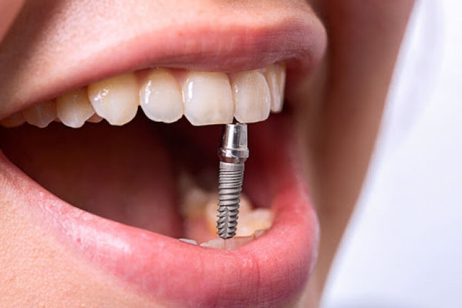 Имплантация зубов: кому можно делать и как происходит процедура