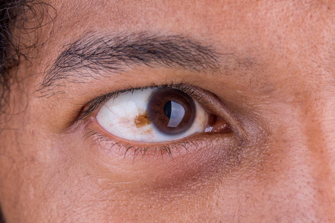 Три симптома в глазах, указывающие на дефицит витамина В12