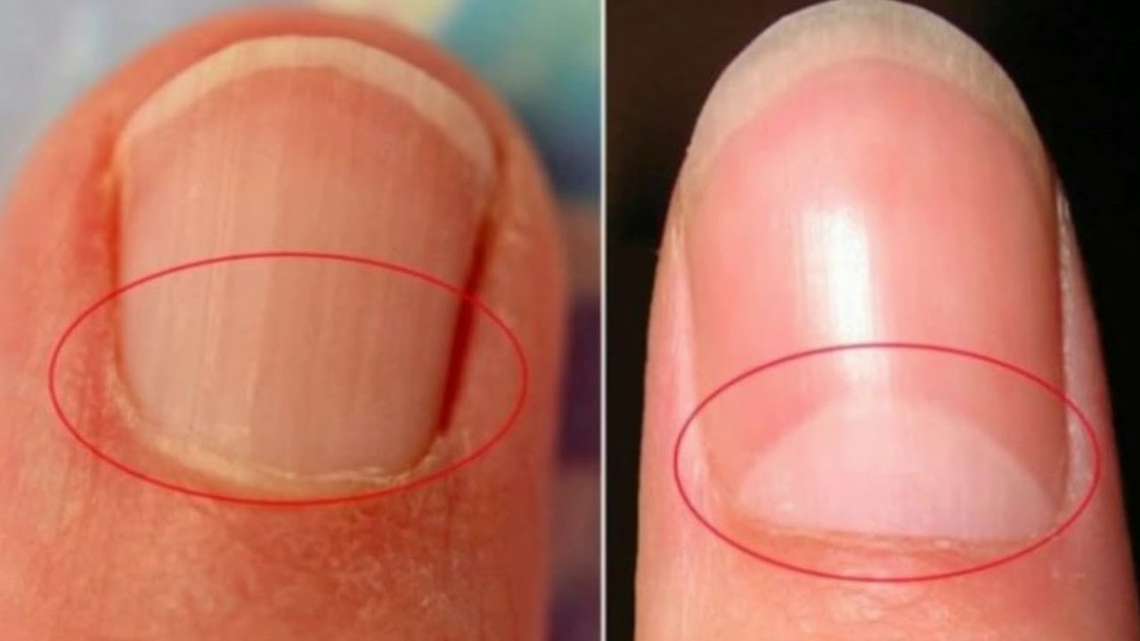 Полоски на ногтях причины вертикальные у женщин. Ониходистрофия - онихолизис.. Онихорексис онихомикоз. Ногтевая пластина.