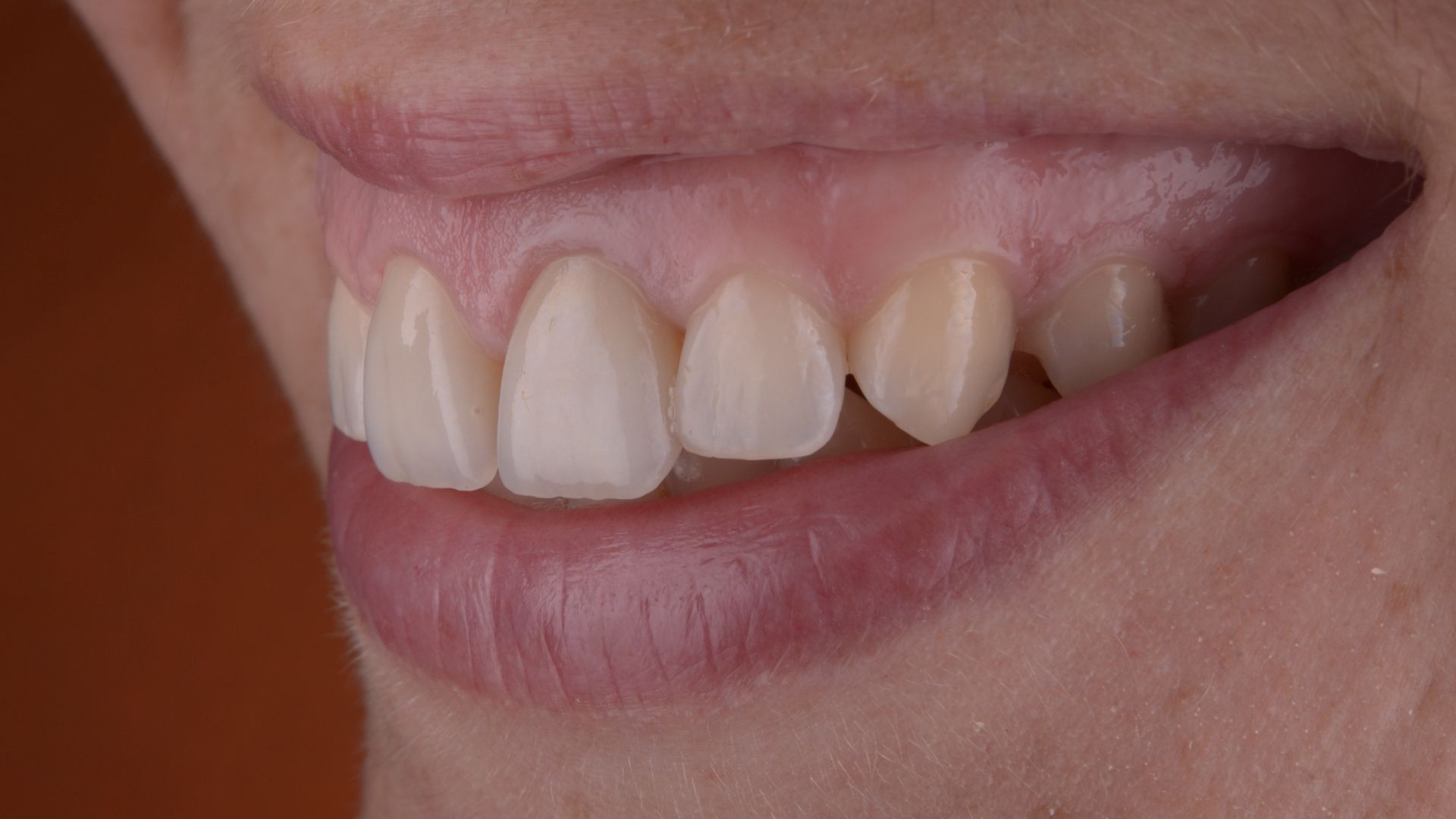 Как устранить оголение шейки зуба и не допустить потерю зубов .