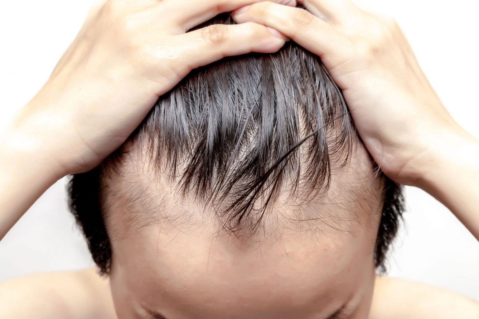 Выпадение волос может быть симптомом вич