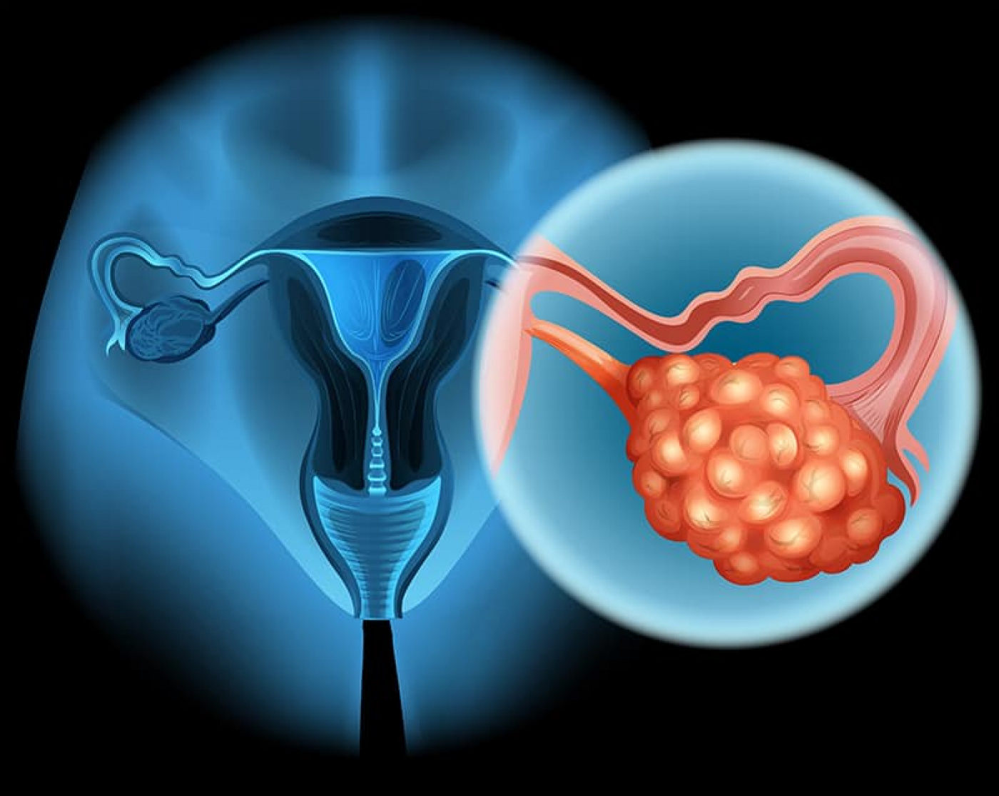 рак яичников у женщин фото
